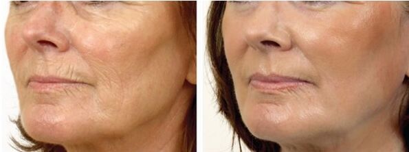Virun an nom Laser Peeling