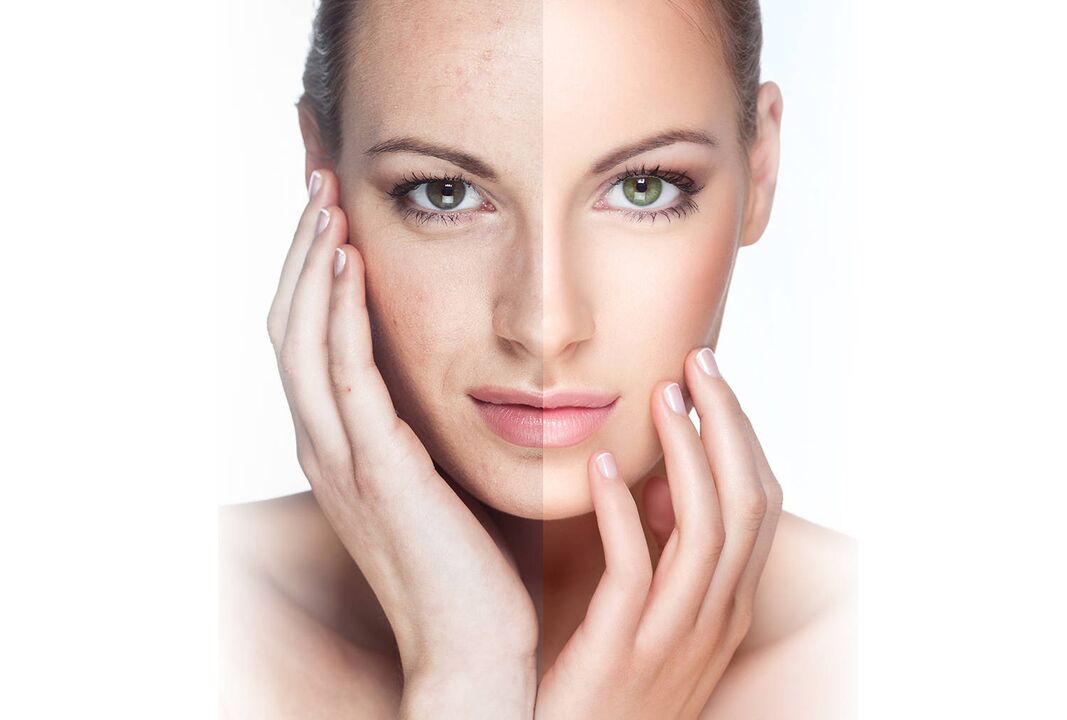 Laser Rejuvenation Resultat