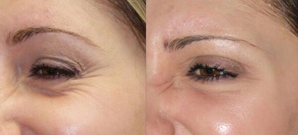 Rejuvenatioun vun der Haut vun den Augen