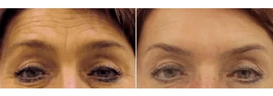 Apparater fir fraktionell Verjéngung