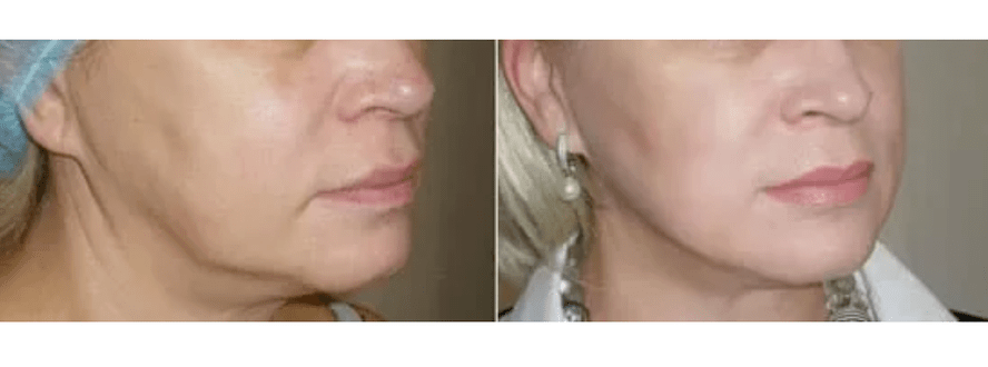 Erhuelung no der Hautverjüngung